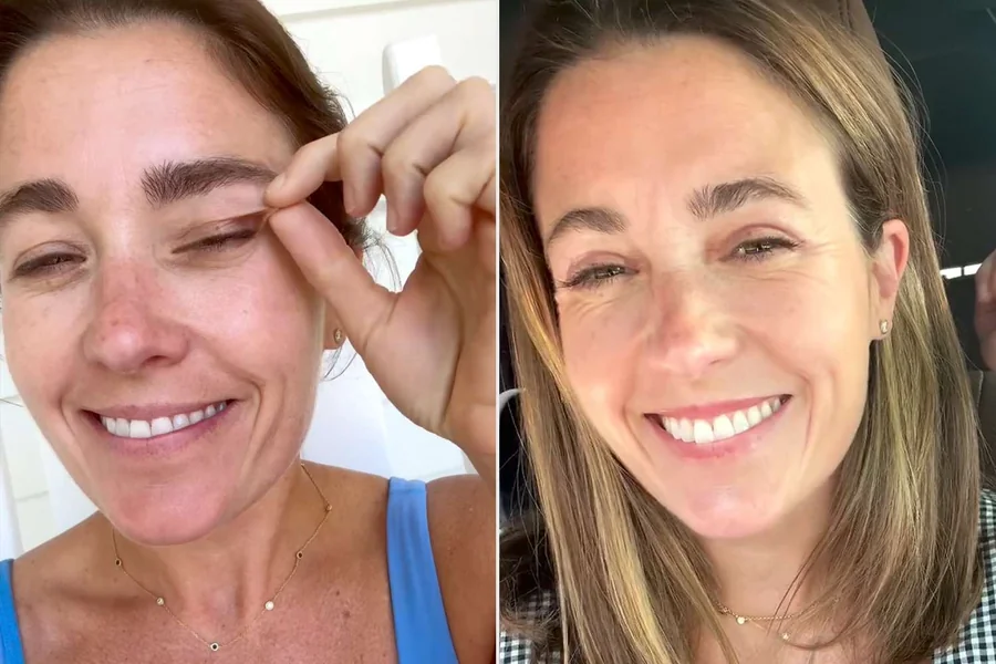 Eyelid Surgery